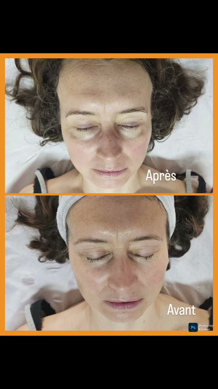 Vidéo Mésoesthétique sans injection Anti-Age Visage 60 min, possobilité en cure chez Body Perfect by Marysa