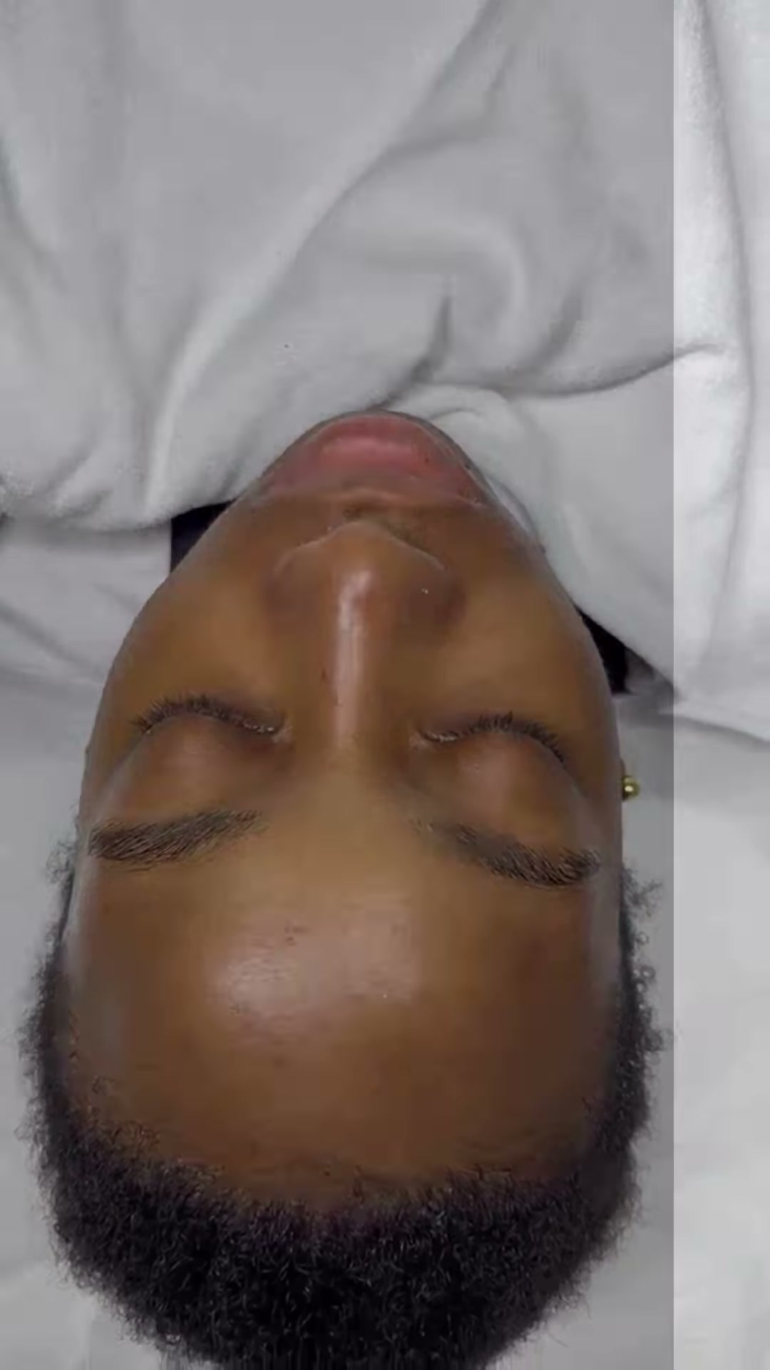 Vidéo Carboxytherapie chez Maria Dias Skin Expert